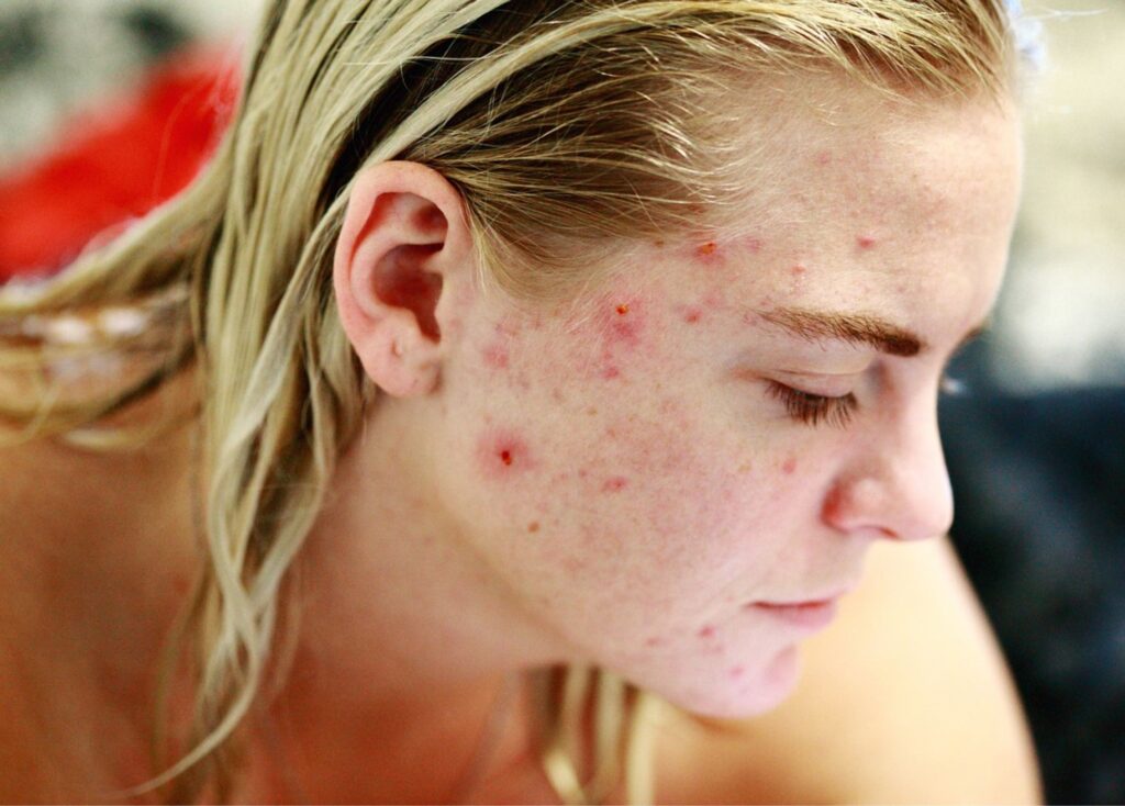 Frau mit hormonell bedingter Akne im Wangen- und Stirnbereich – Symbol für Iris’ Hautberatung bei inneren Ungleichgewichten